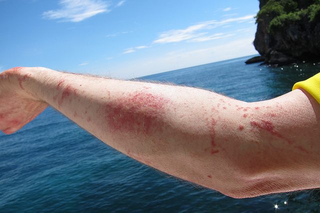 Jellyfish sting – Author: Thomas Quine – CC BY 2.0