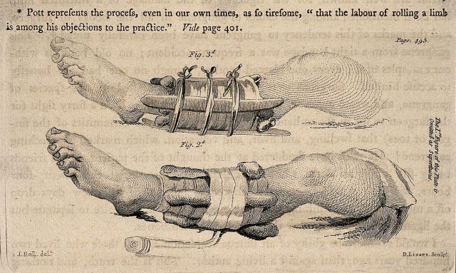 Two diagrams of legs in splints, illustrating how to set a fractured limb. Stipple engraving by D. Lizars after J. Bell. – Author: http://wellcomeimages.org/indexplus/obf_images/a9/97/b646bfa740d282ce29716bdbb9aa.jpg – CC BY 4.0