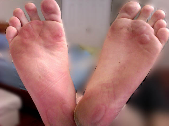 Friction blisters due to running barefoot. – Author: AndryFrench – CC BY 3.0
