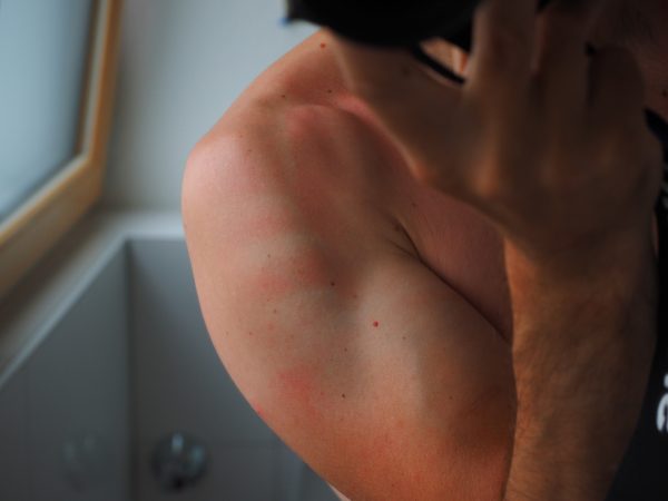 When you apply sunscreen, it is easy to miss a spot