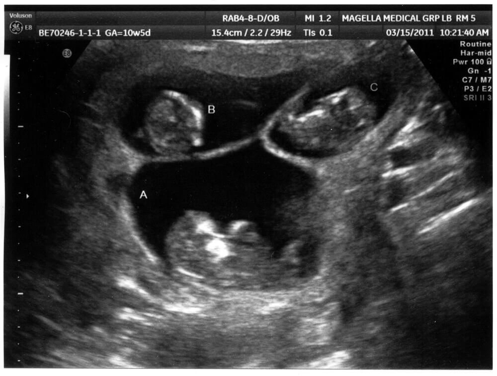 ultrasound_3-15-11-all21