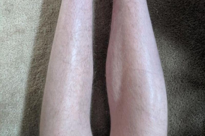 left leg and right leg for comparison