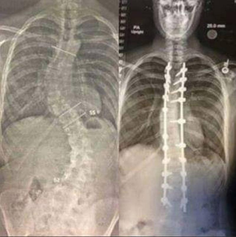 x-rays show before (crooked spine) and after (spine straighter with rods) 