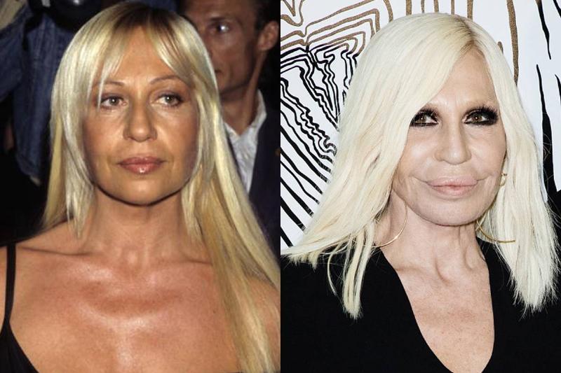 donatella-versache-before-after-plastic-surgery
