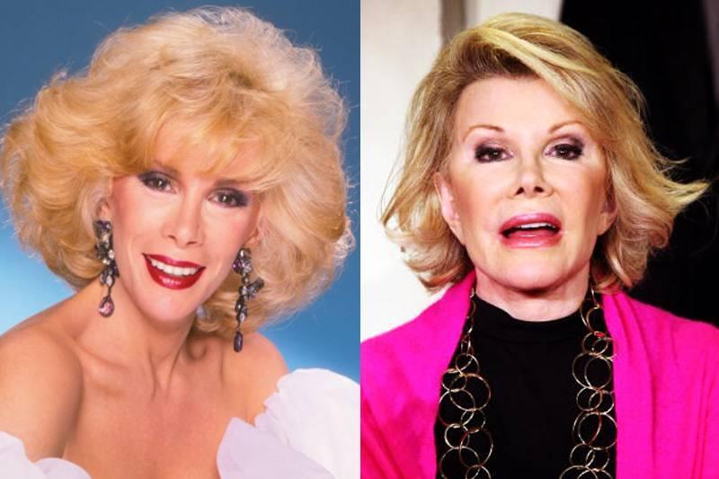 joan-rivers-plastic-surgery