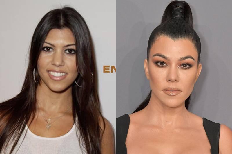 kourtney-kardashian-plastic-surgery