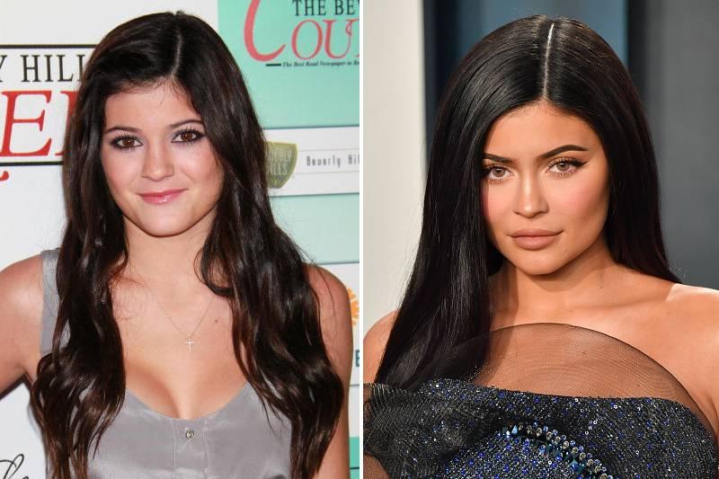 kylie-jenner-plastic-surgery