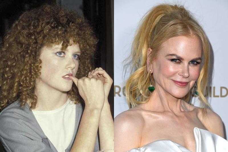 nicole-kidman-plastic-surgery