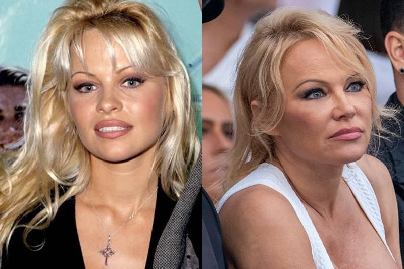 pamela-anderson-plastic-surgery