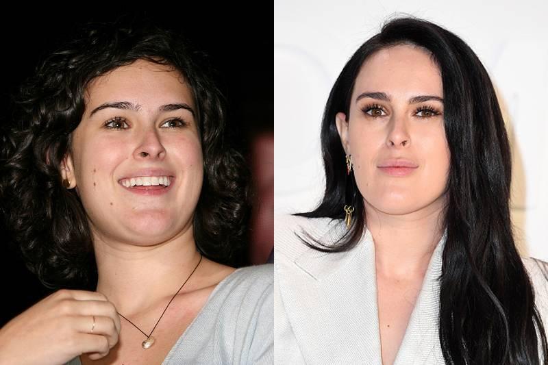 rumer-willis-plastic-surgery