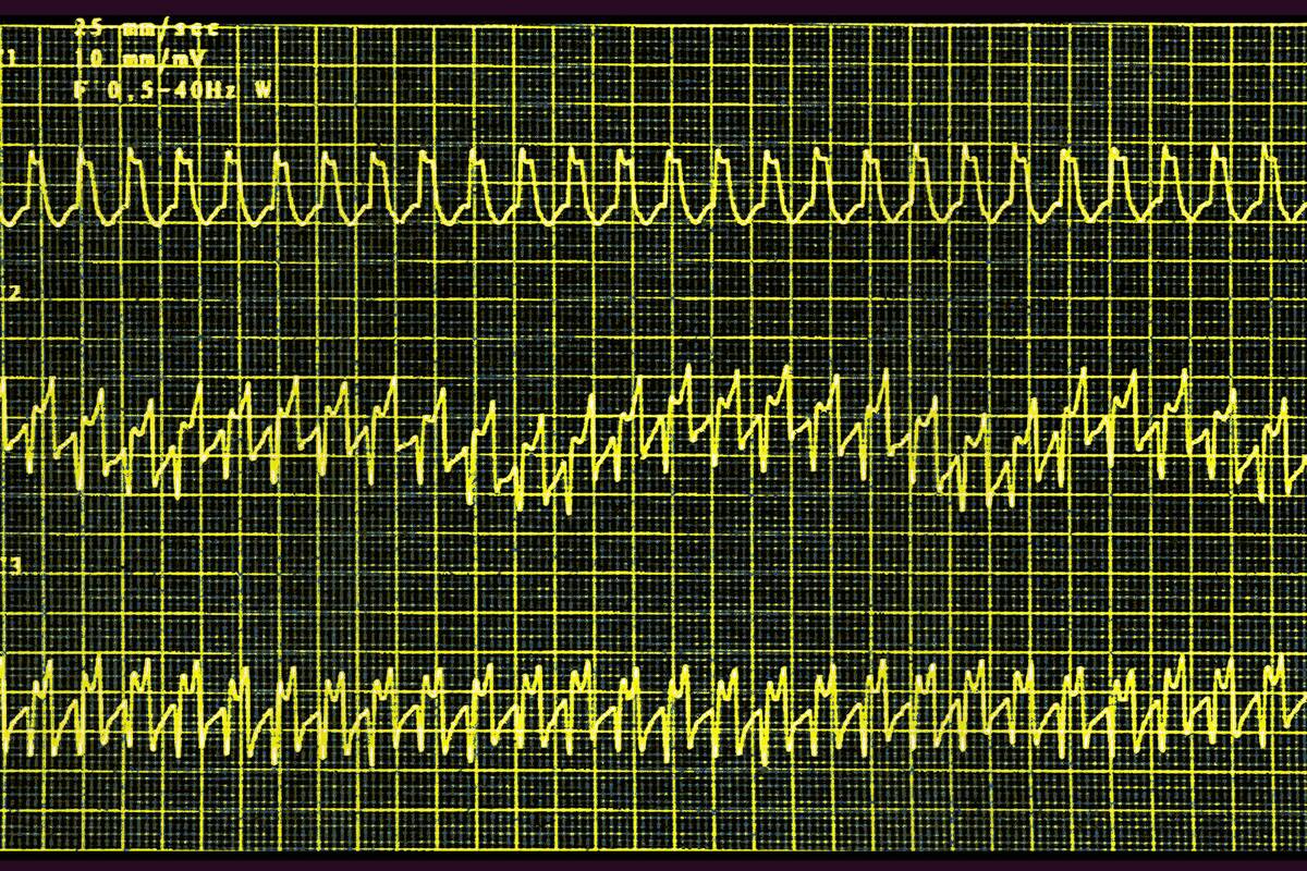 Atrial tachycardia
