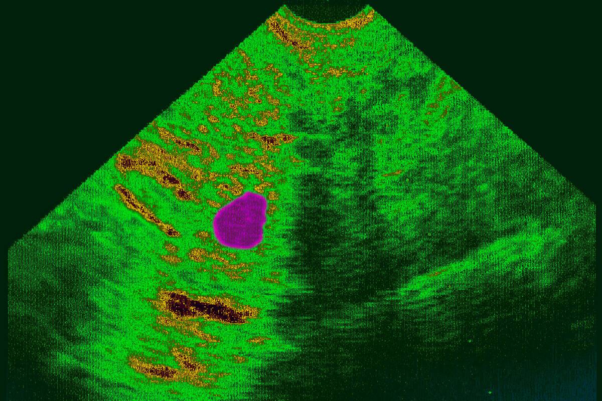 Extra-uterine pregnancy