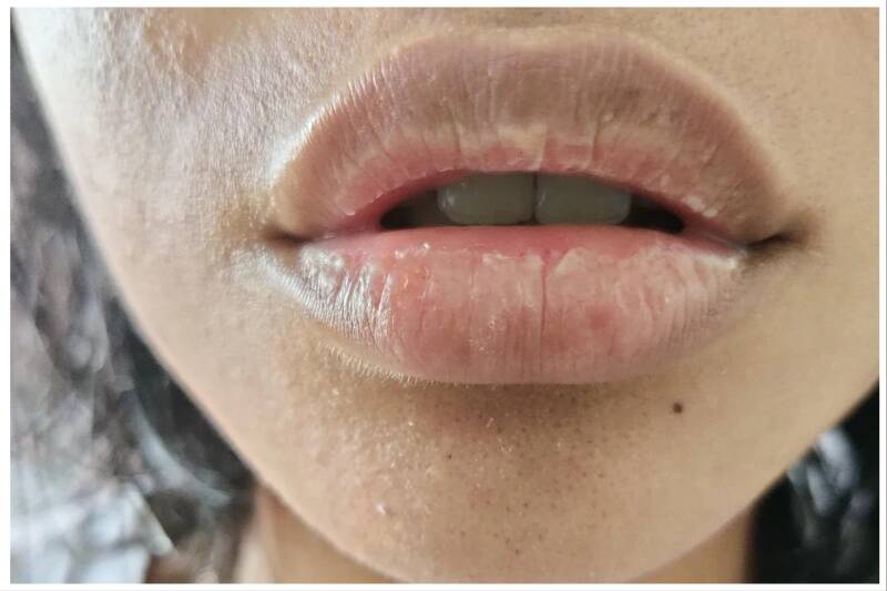 Chapped lips