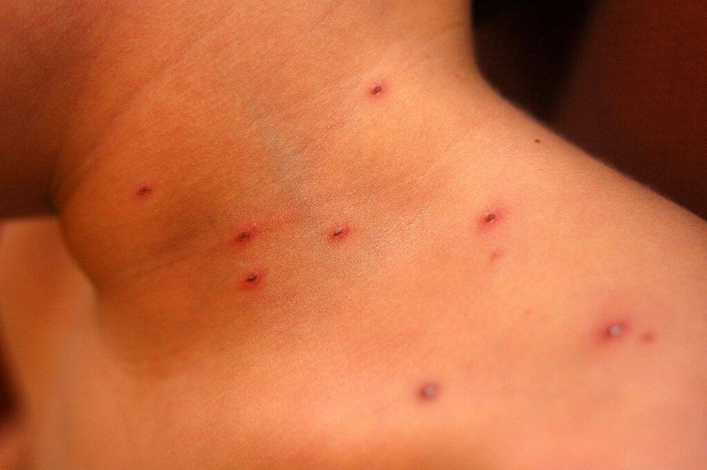 Chicken Pox