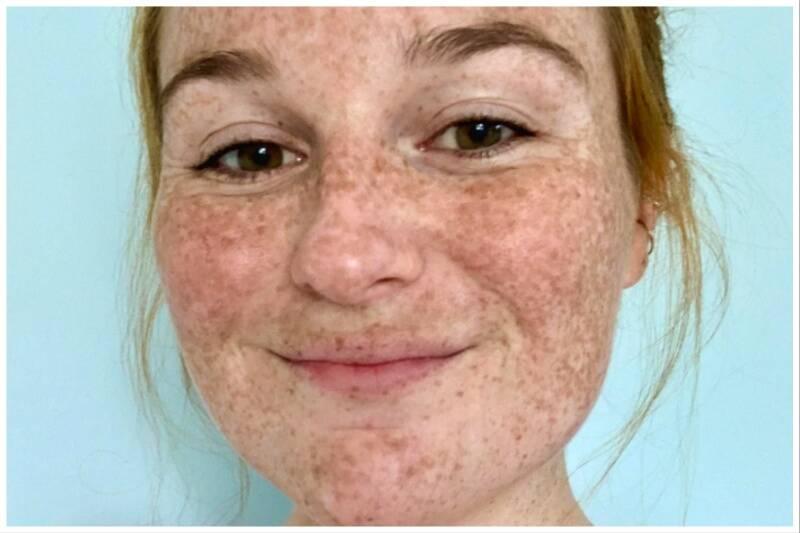 Freckles and Sunspots