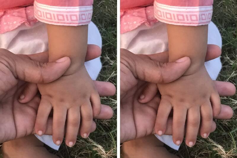 polydactyly2