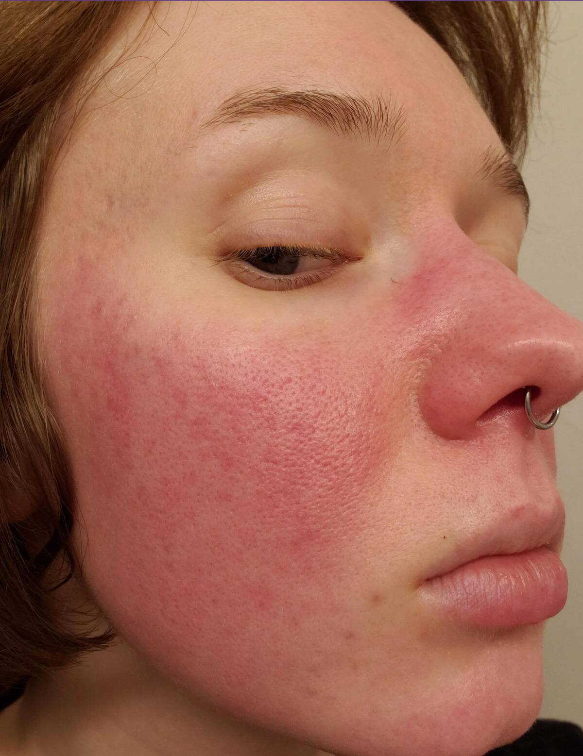 cheek rash