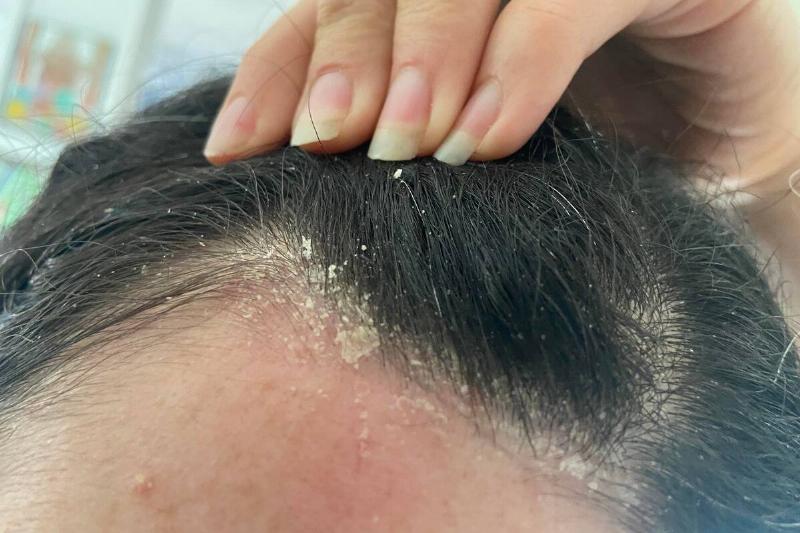 dandruff