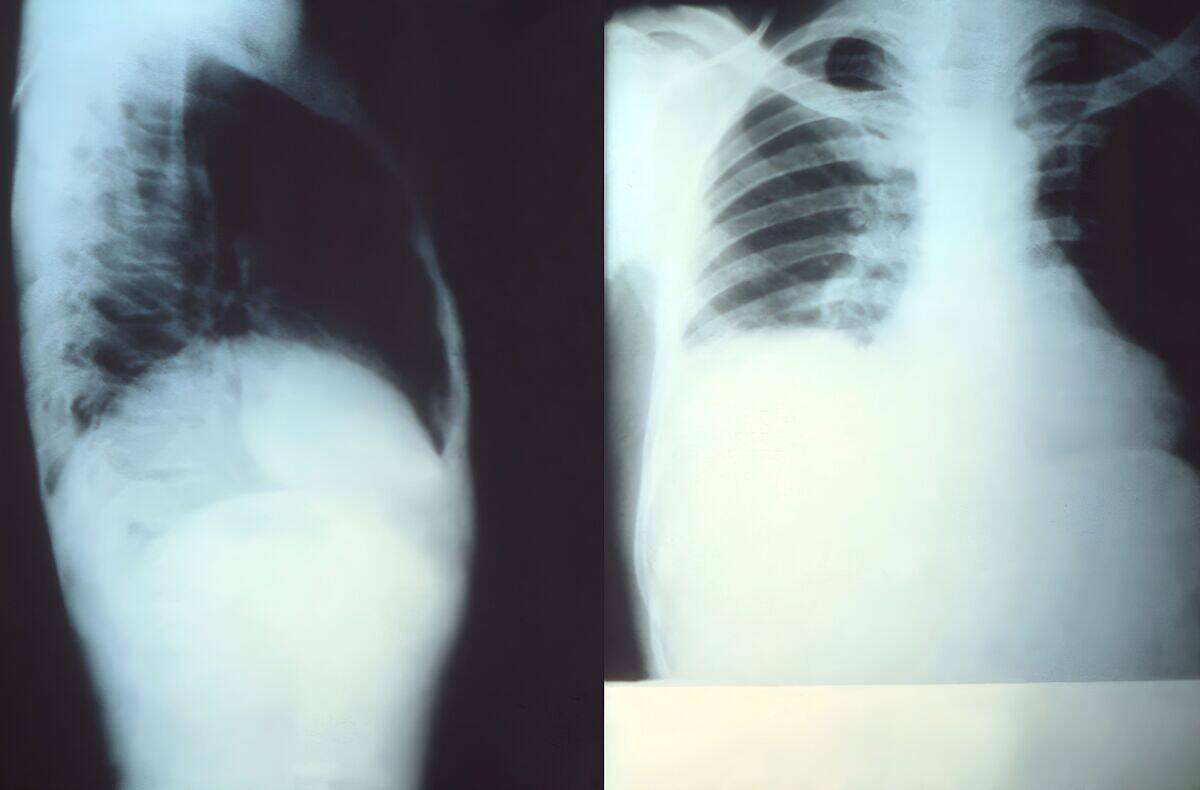 X-ray hepatomegaly