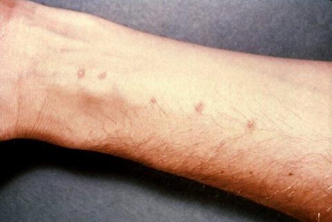 schistosomiasis_itch-640x429-1-59292