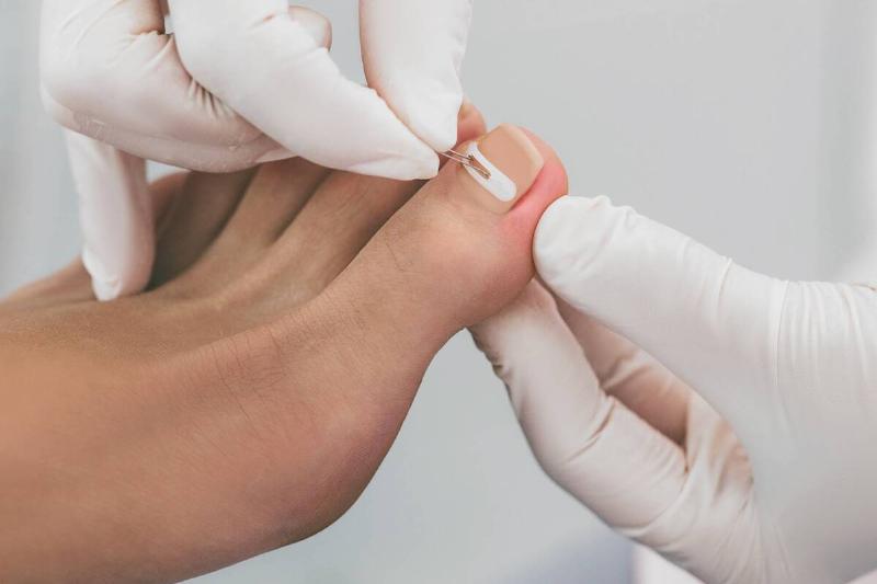 Doctor treating ingrown toenail. 