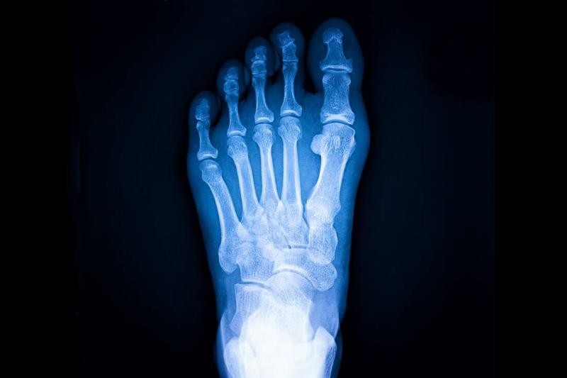 X-ray of foot. 