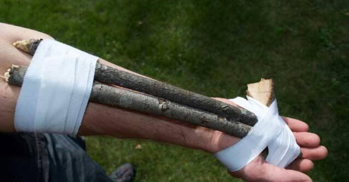 An arm with two sticks tied to it, functioning as a splint.