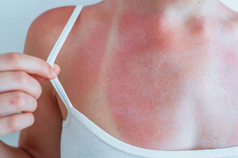 A woman showing her sunburn on her shoulders. 