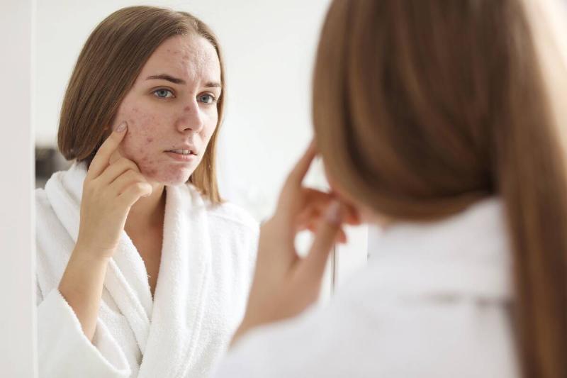 Young woman with acne problem near mirror in bathroom.