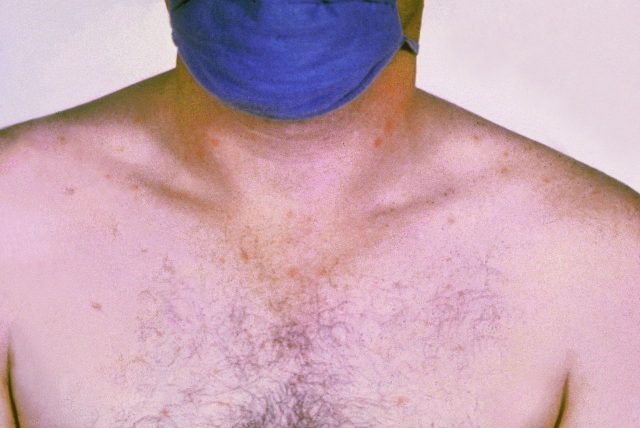 Rose colored spots on the chest of a person with typhoid fever