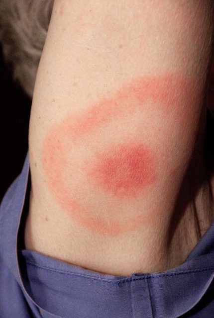 The classic bull’s-eye rash that can develop after bites