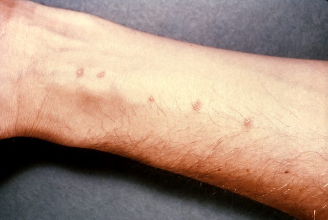 Skin blisters on the forearm, created by the entrance of Schistosoma parasite – image source
