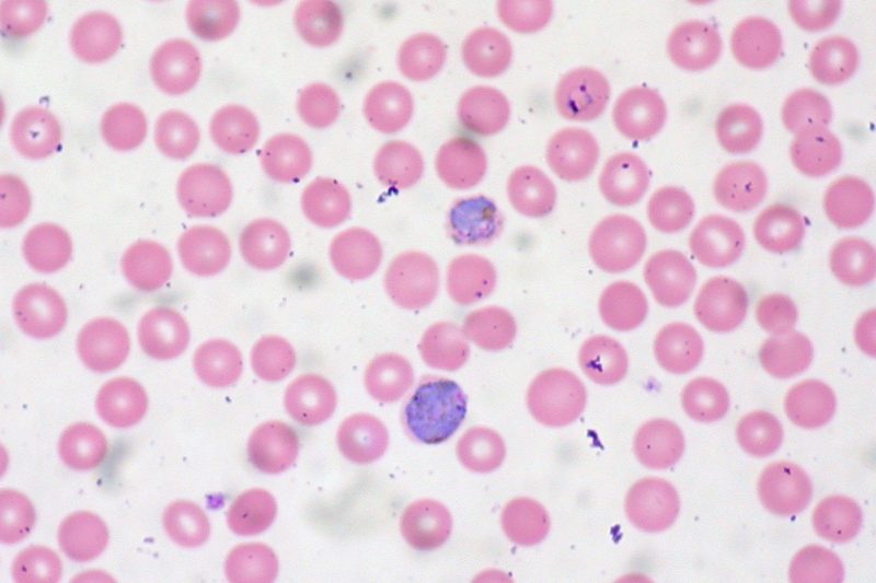 Malaria in Peripheral Blood – Author: Ed Uthman – CC BY 2.0