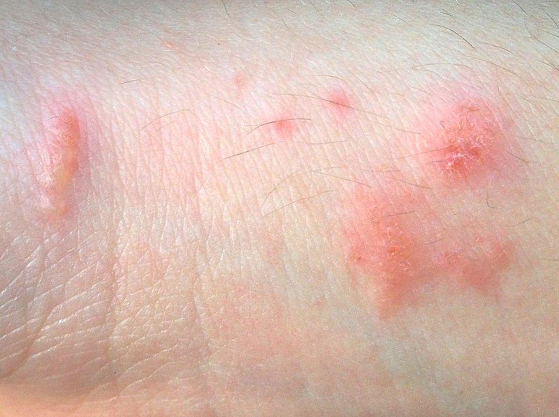 Urushiol-induced contact dermatitis from poison oak – Author: Britannic124 – CC BY-SA 3.0
