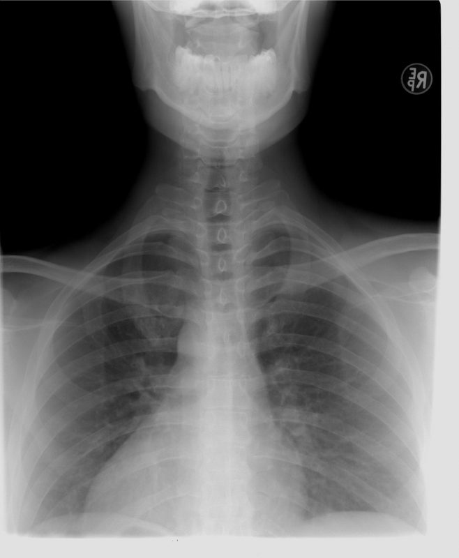 X ray of an injured spine